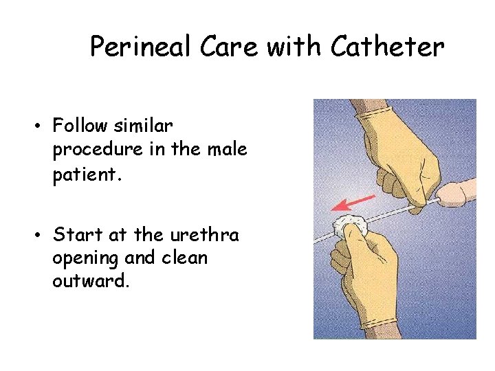 Perineal Care with Catheter • Follow similar procedure in the male patient. • Start