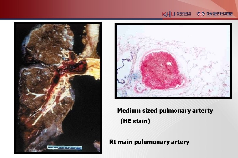 Medium sized pulmonary arterty (HE stain) Rt main pulumonary artery 