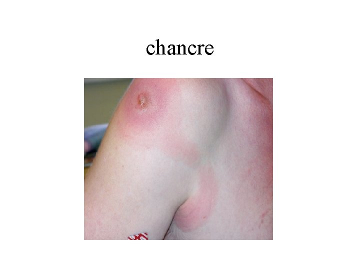chancre 