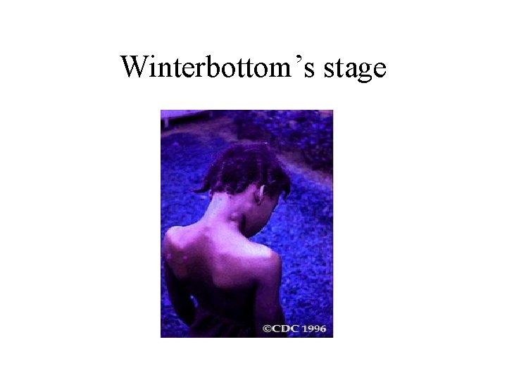 Winterbottom’s stage 