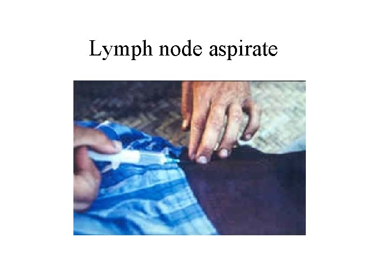 Lymph node aspirate 