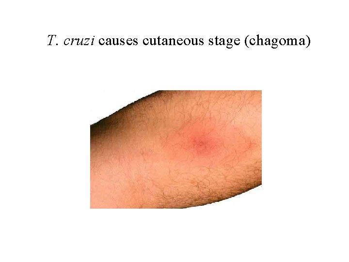 T. cruzi causes cutaneous stage (chagoma) 