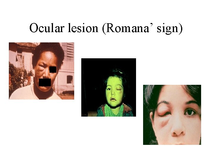 Ocular lesion (Romana’ sign) 
