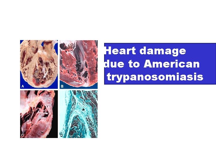 Heart damage due to American trypanosomiasis 