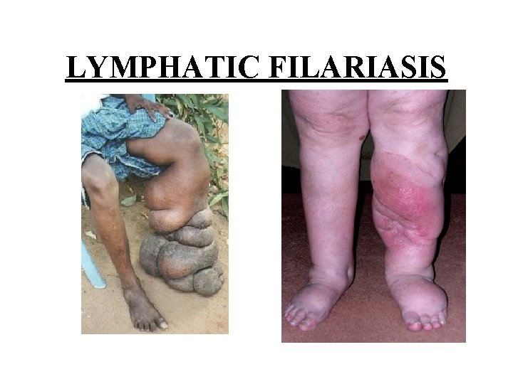 LYMPHATIC FILARIASIS 