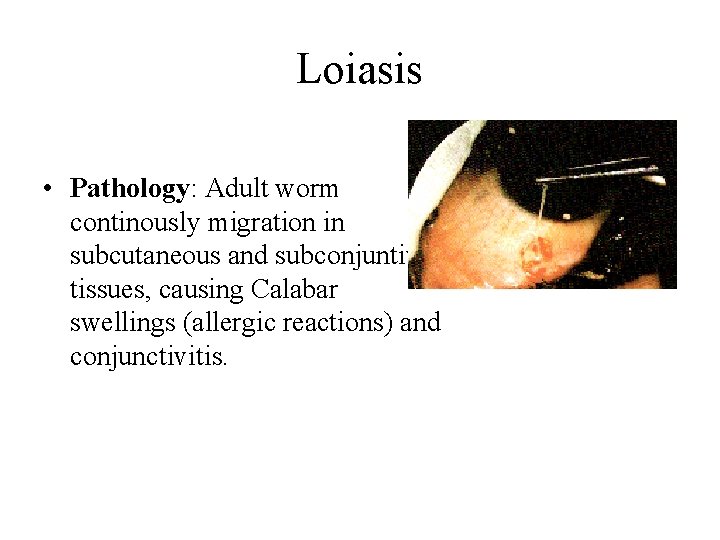 Loiasis • Pathology: Adult worm continously migration in subcutaneous and subconjuntival tissues, causing Calabar
