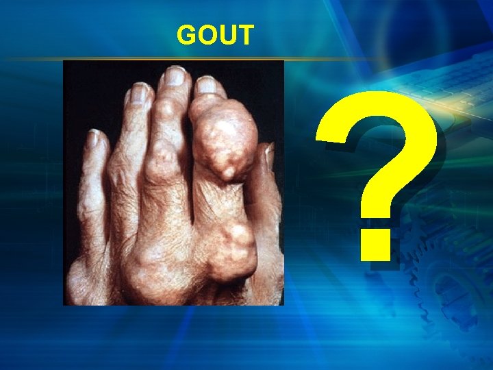 GOUT ? 