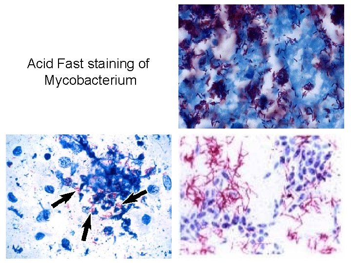 Acid Fast staining of Mycobacterium  Acid Fast staining of Mycobacterium