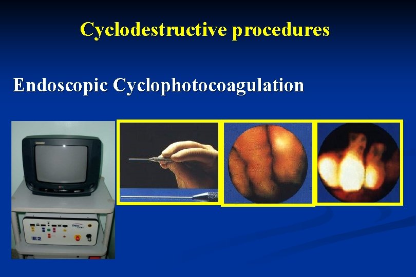 Cyclodestructive procedures Endoscopic Cyclophotocoagulation 