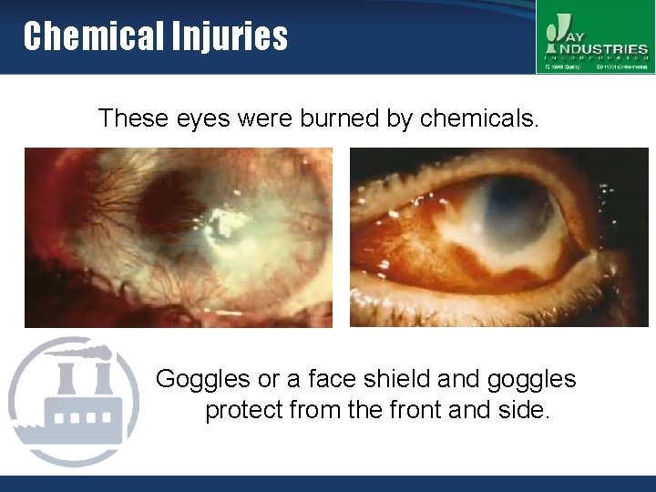 Chemical Injuries These eyes were burned by chemicals. Goggles or a face shield and
