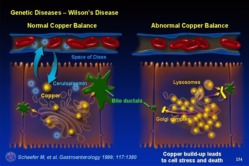 Wilson’s Disease Genetic Diseases – Wilson’s Disease Normal Copper Balance Abnormal Copper Balance Space
