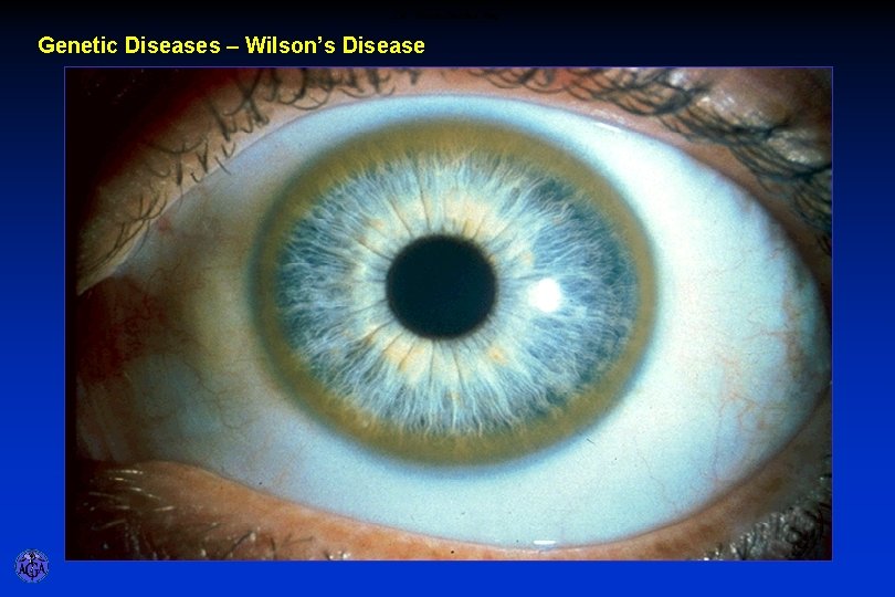 CM - Kayser-Fleischer Ring Genetic Diseases – Wilson’s Disease 