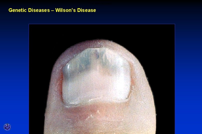 CM - Wilson’s Disease Genetic Diseases – Wilson’s Disease 