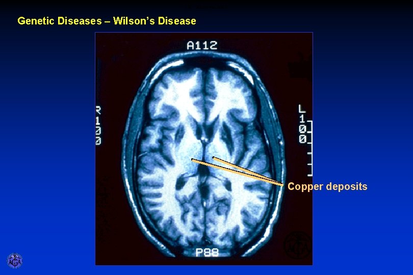 CM - MRI of the Brain Genetic Diseases – Wilson’s Disease Copper deposits 