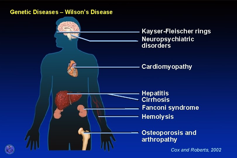 Wilson’s Disease Genetic Diseases – Wilson’s Disease Kayser-Fleischer rings Neuropsychiatric disorders Cardiomyopathy Hepatitis Cirrhosis Wilson’s Disease Genetic Diseases – Wilson’s Disease Kayser-Fleischer rings Neuropsychiatric disorders Cardiomyopathy Hepatitis Cirrhosis