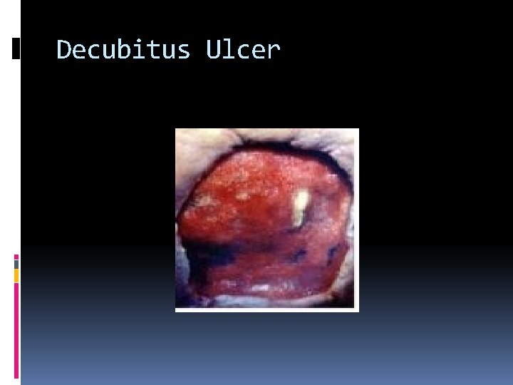 Decubitus Ulcer 
