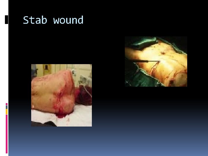 Stab wound 