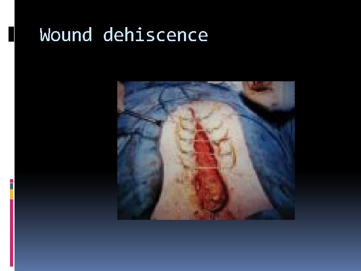 Wound dehiscence 