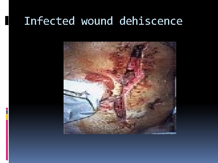 Infected wound dehiscence 