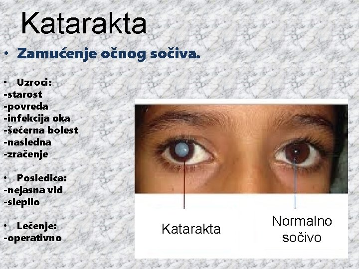 Katarakta • Zamućenje očnog sočiva. • Uzroci: -starost -povreda -infekcija oka -šećerna bolest -nasledna
