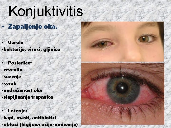 Konjuktivitis • Zapaljenje oka. • Uzrok: -bakterije, virusi, gljivice • Posledice: -crvenilo -suzenje -svrab