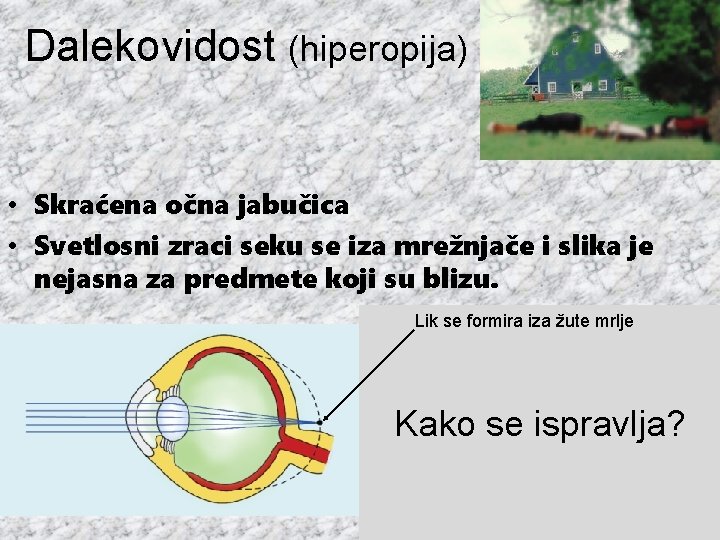 Dalekovidost (hiperopija) • Skraćena očna jabučica • Svetlosni zraci seku se iza mrežnjače i