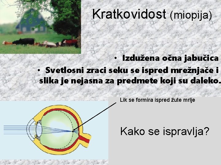 Kratkovidost (miopija) • Izdužena očna jabučica • Svetlosni zraci seku se ispred mrežnjače i