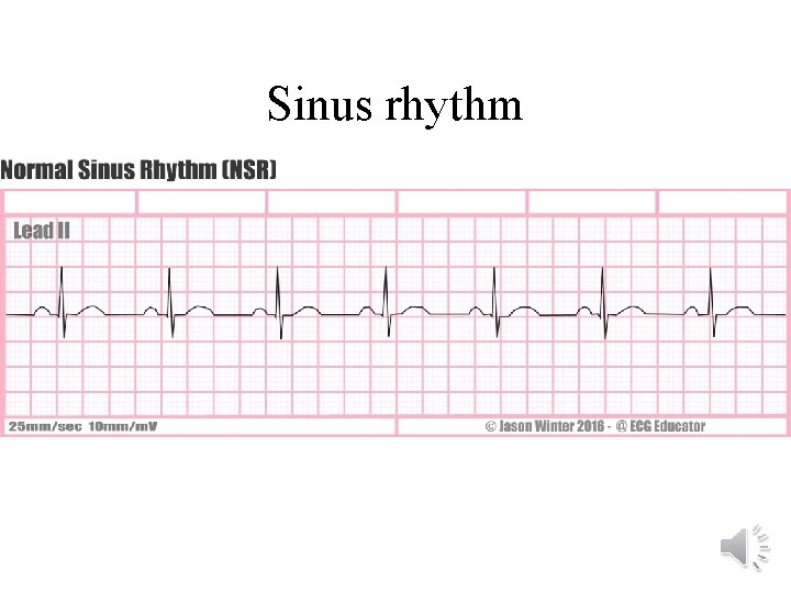 Sinus rhythm 