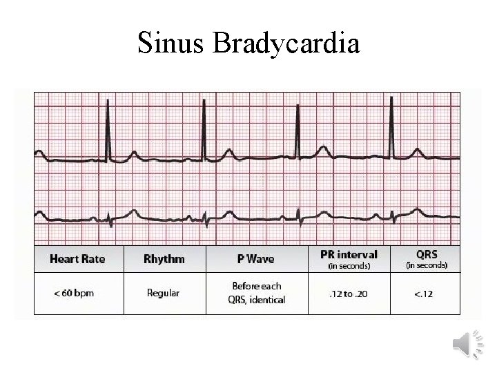 Sinus Bradycardia 