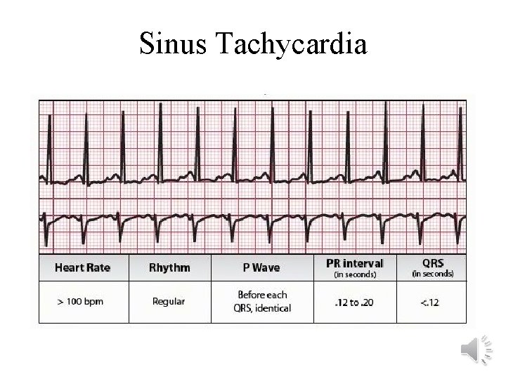 Sinus Tachycardia 