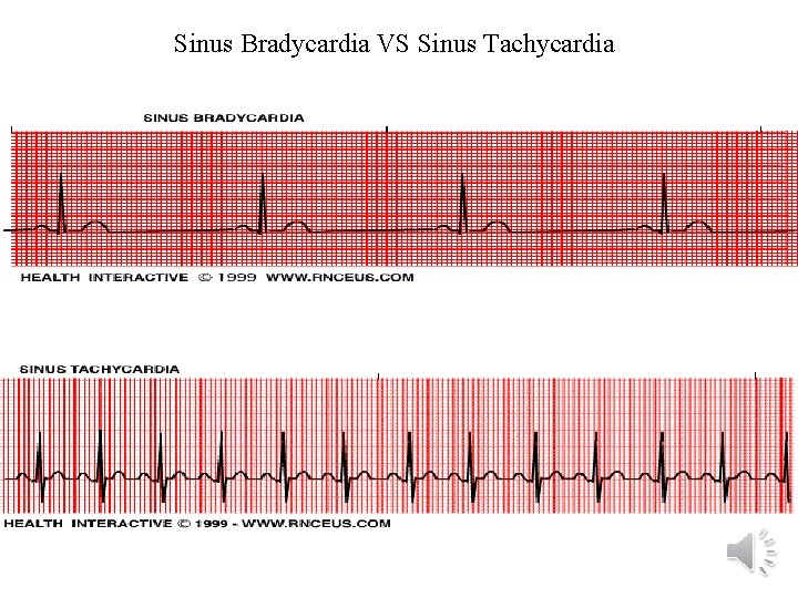 Sinus Bradycardia VS Sinus Tachycardia 