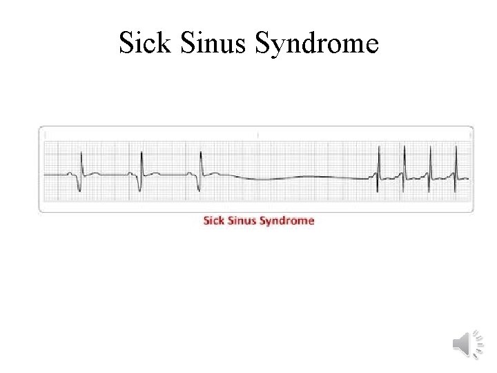 Sick Sinus Syndrome 