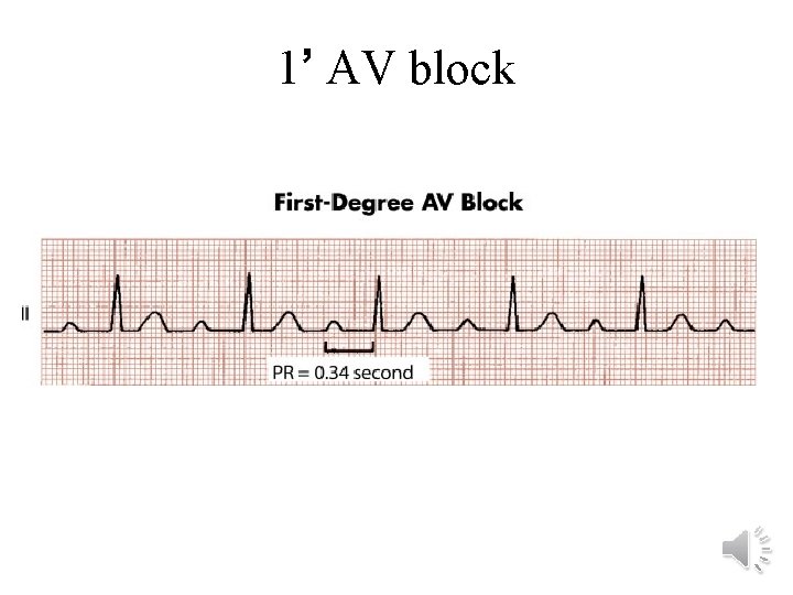 1’ AV block 