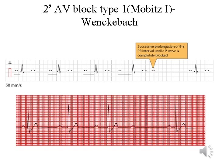 2’ AV block type 1(Mobitz I)Wenckebach 