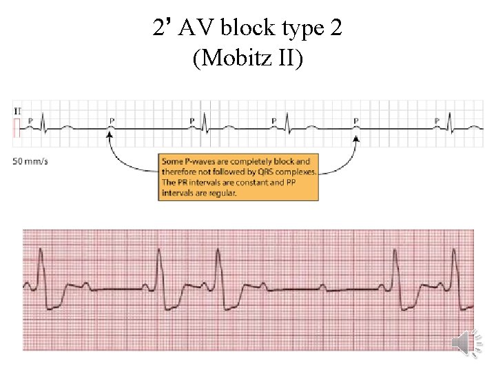 2’ AV block type 2 (Mobitz II) 