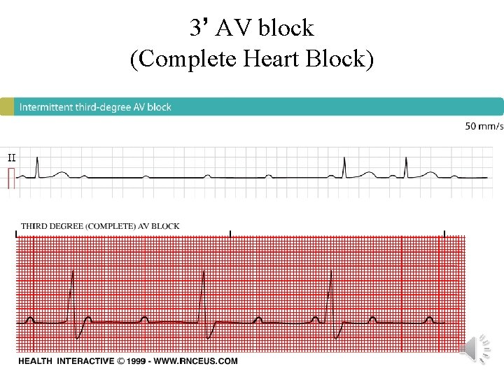 3’ AV block (Complete Heart Block) 