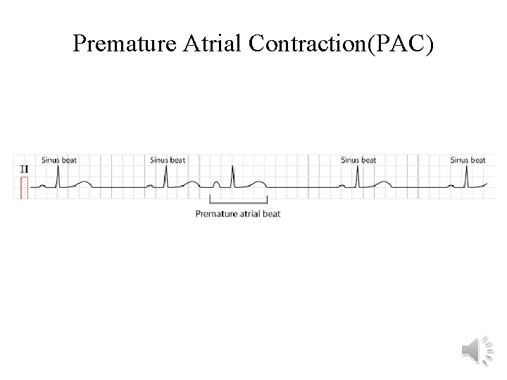 Premature Atrial Contraction(PAC) 