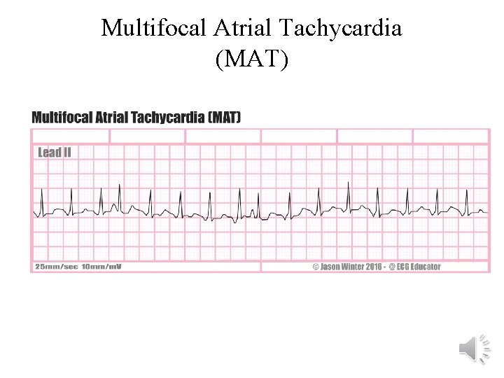 Multifocal Atrial Tachycardia (MAT) 