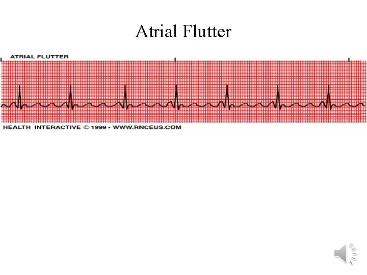 Atrial Flutter 