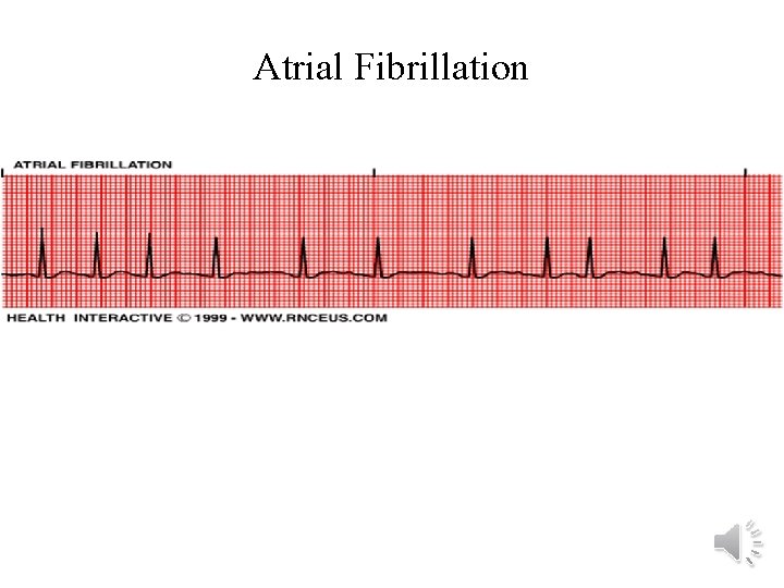 Atrial Fibrillation 