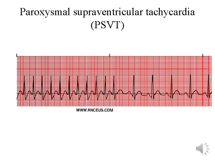 Paroxysmal supraventricular tachycardia (PSVT) 