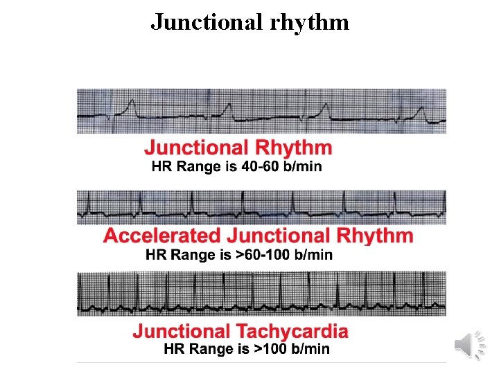 Junctional rhythm 