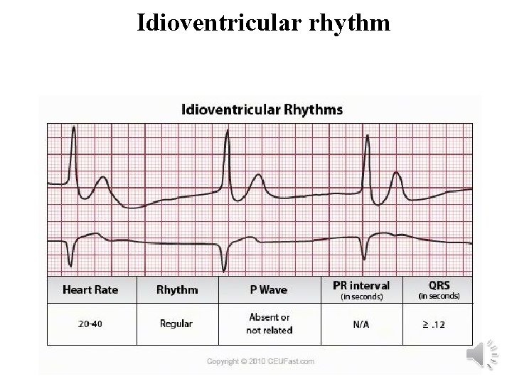 Idioventricular rhythm 