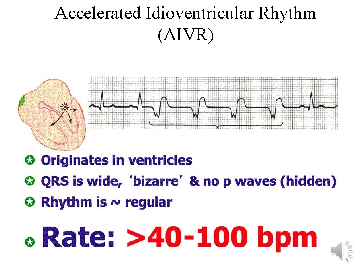 Accelerated Idioventricular Rhythm (AIVR) 