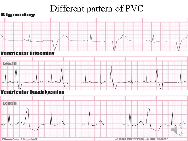 Different pattern of PVC 