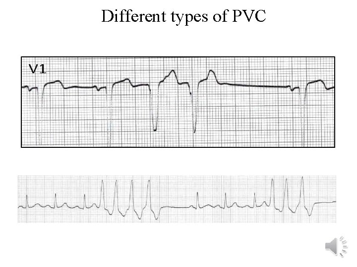 Different types of PVC 