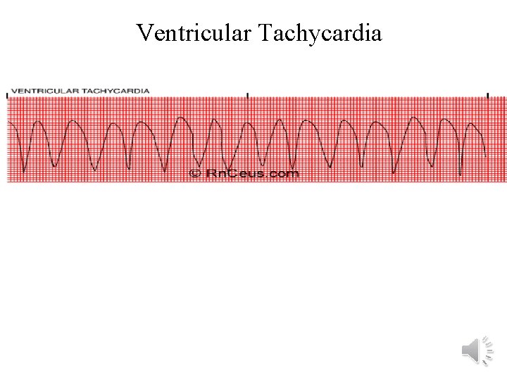 Ventricular Tachycardia 