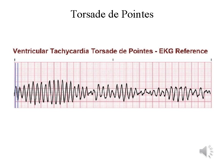 Torsade de Pointes 