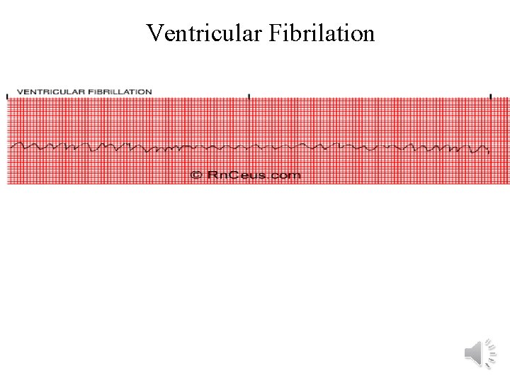 Ventricular Fibrilation 