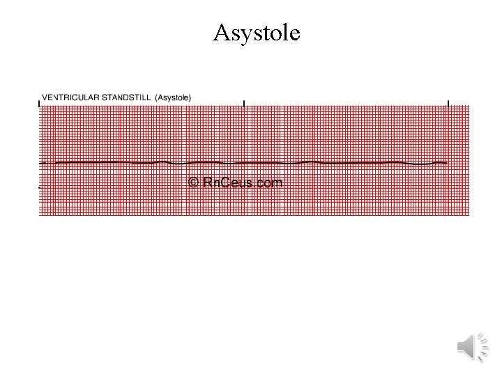 Asystole 